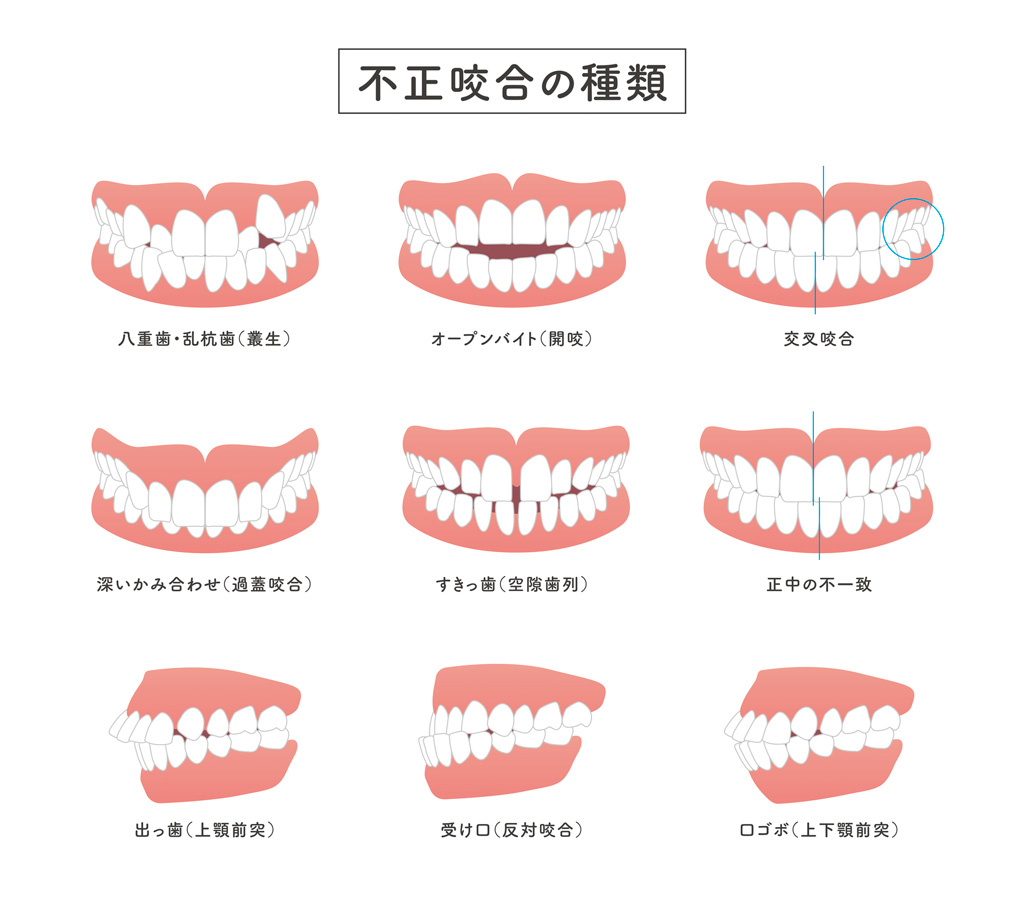 不正咬合の種類